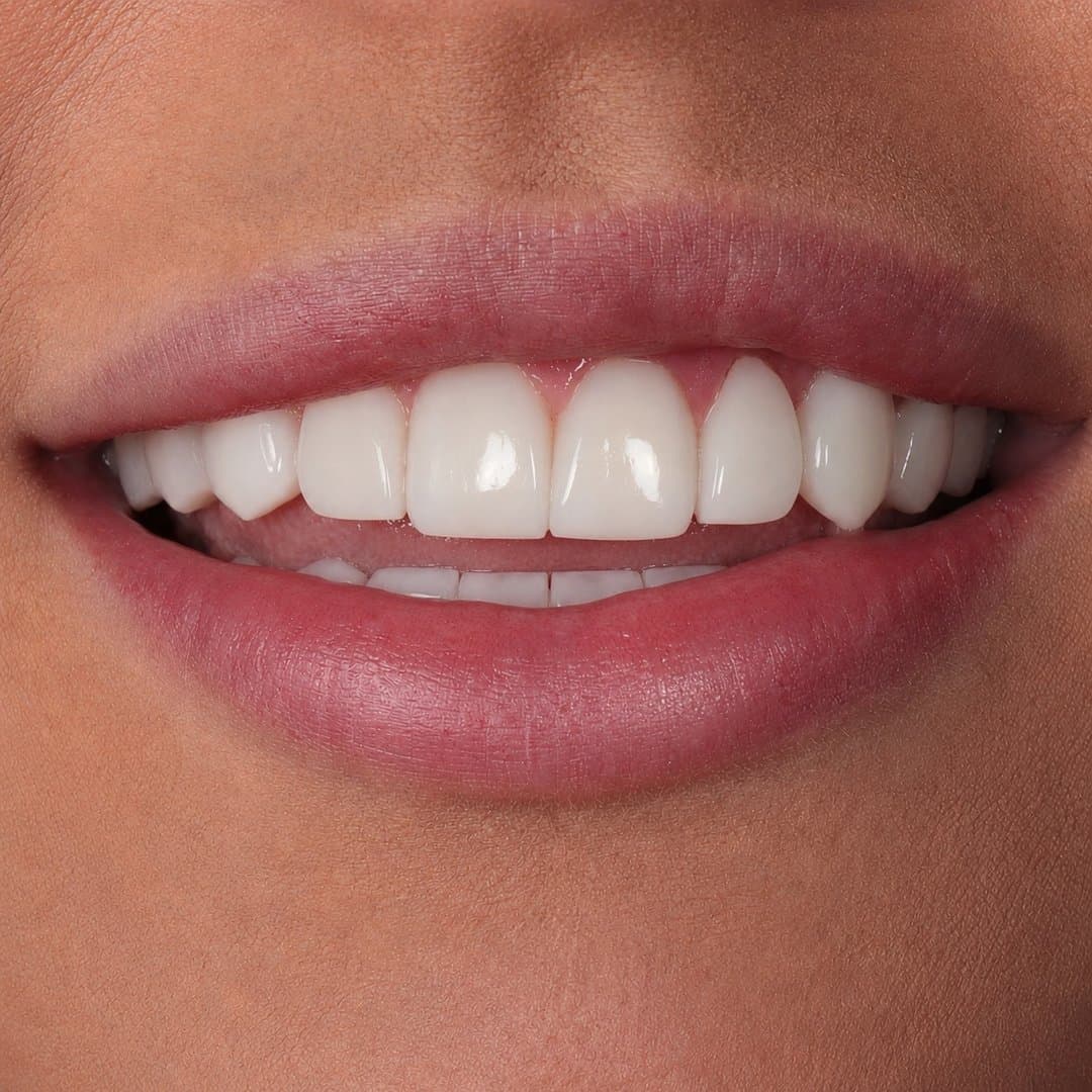 Después — Estética natural · Diseño de sonrisa a medida