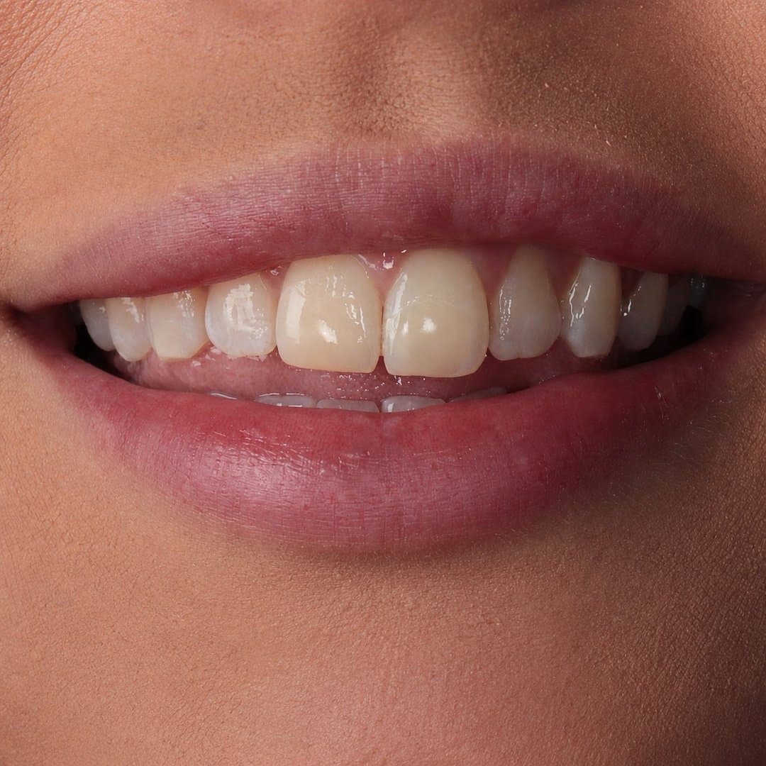 Antes — Estética natural · Diseño de sonrisa a medida