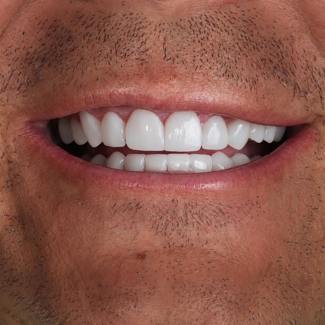 Después — Sonrisa rejuvenecida · Zirconio de alta resistencia