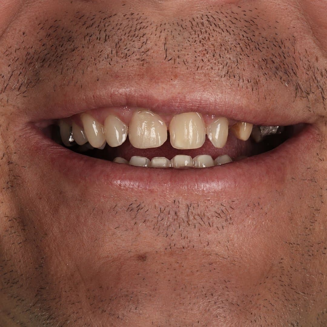 Antes — Sonrisa rejuvenecida · Zirconio de alta resistencia