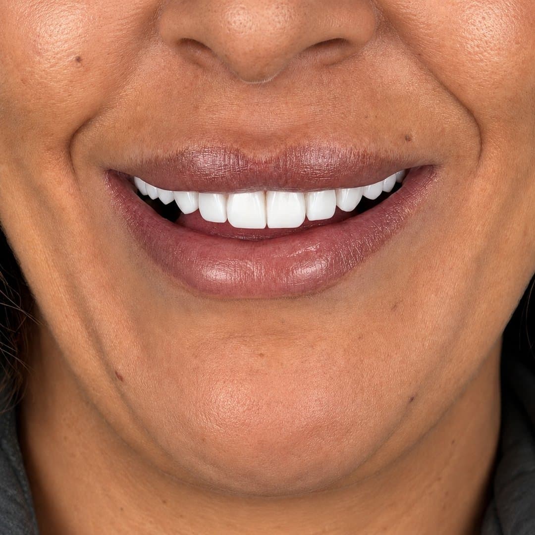 Después — Diseño de sonrisa femenino · Armonía y color a medida