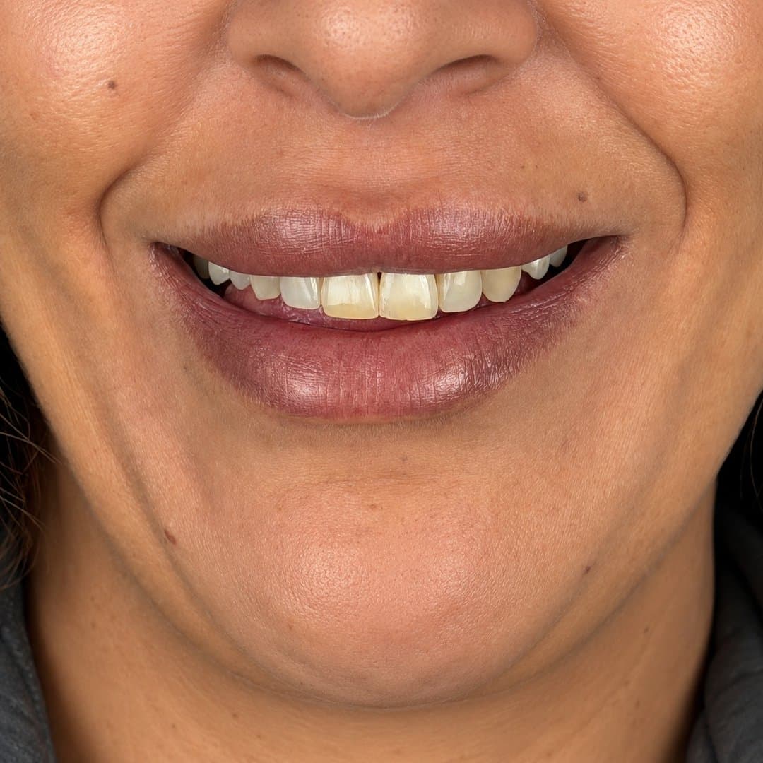 Antes — Diseño de sonrisa femenino · Armonía y color a medida