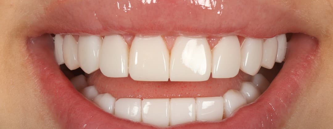 Detalle del acabado de unas carillas de Smiling Clinics