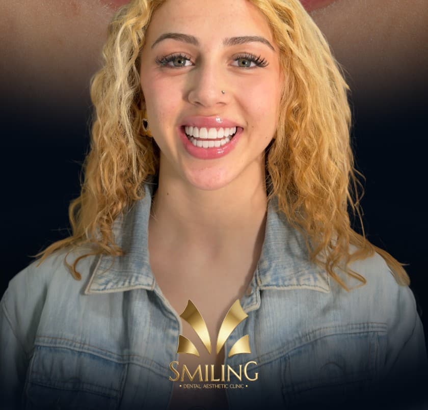 Paciente de Smiling Clinics fotografiada el día de su diseño de sonrisa en Barcelona
