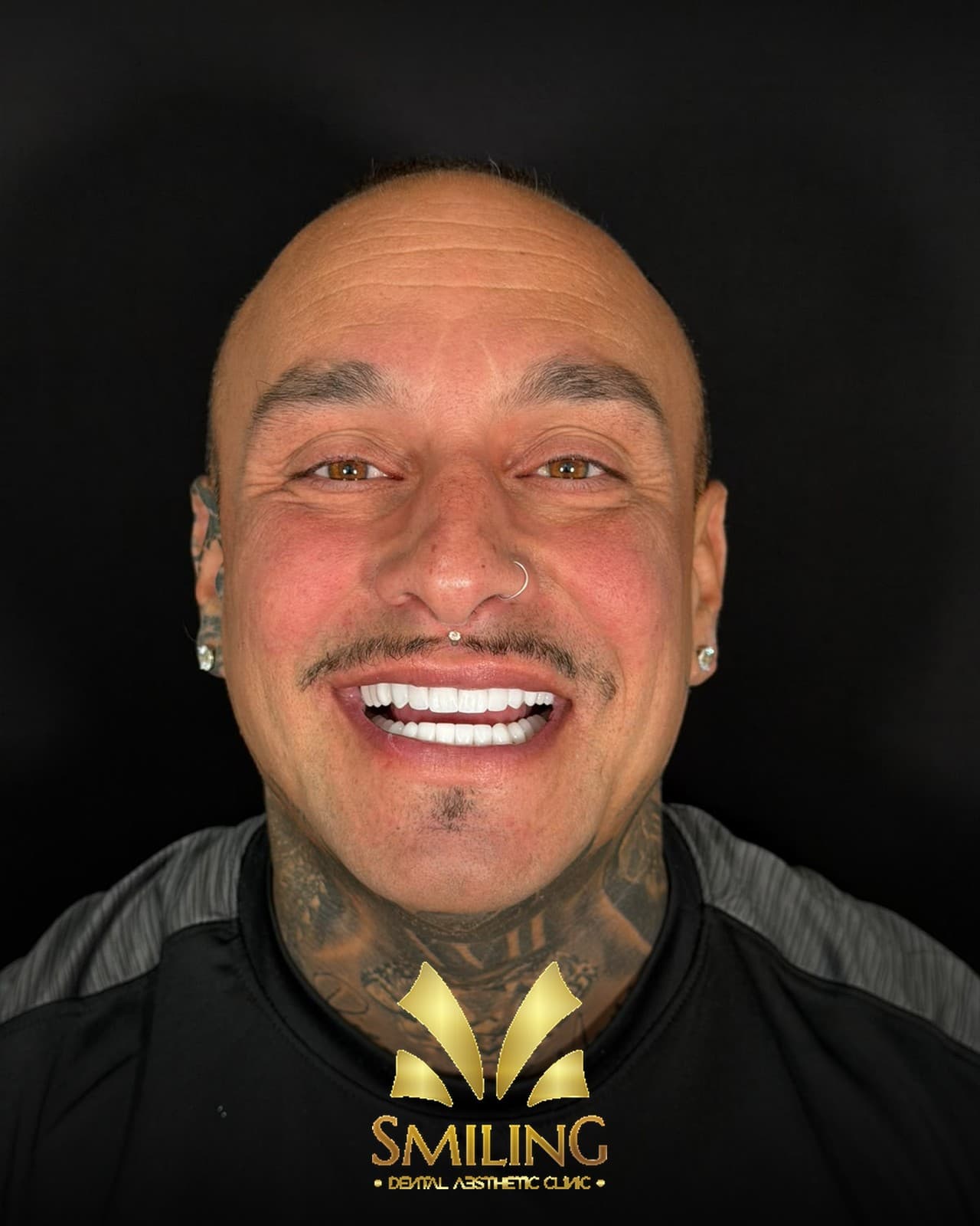Detalle de una sonrisa tratada con composite en Smiling Clinics
