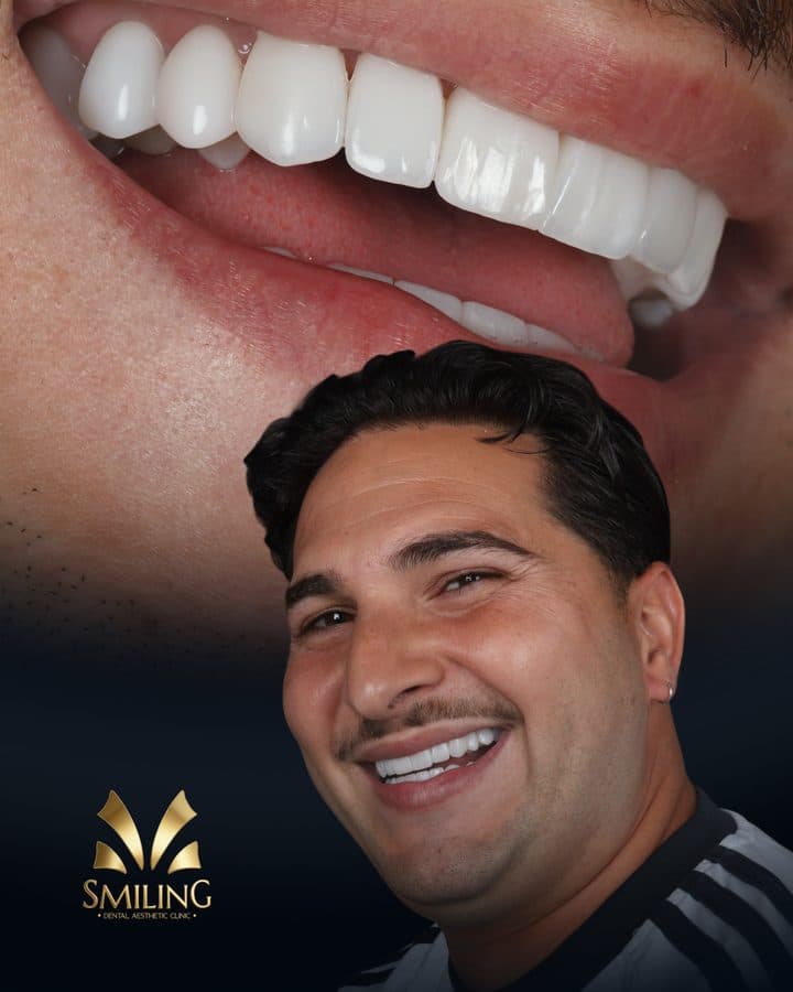 Paciente de Smiling Clinics Barcelona tras su tratamiento con carillas