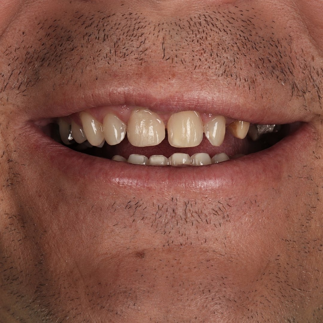 Sonrisa rejuvenecida · Antes del tratamiento