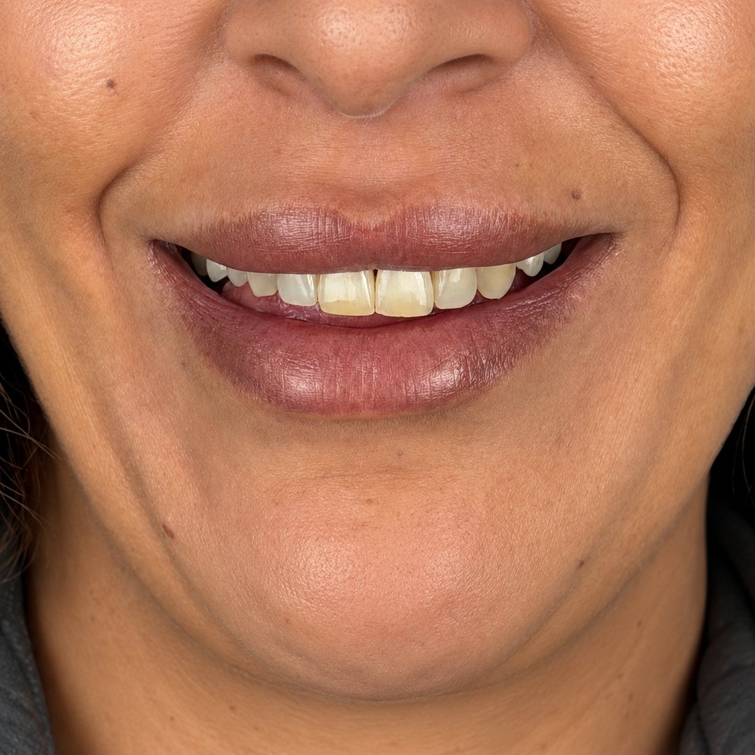 Diseño de sonrisa femenino · Antes del tratamiento