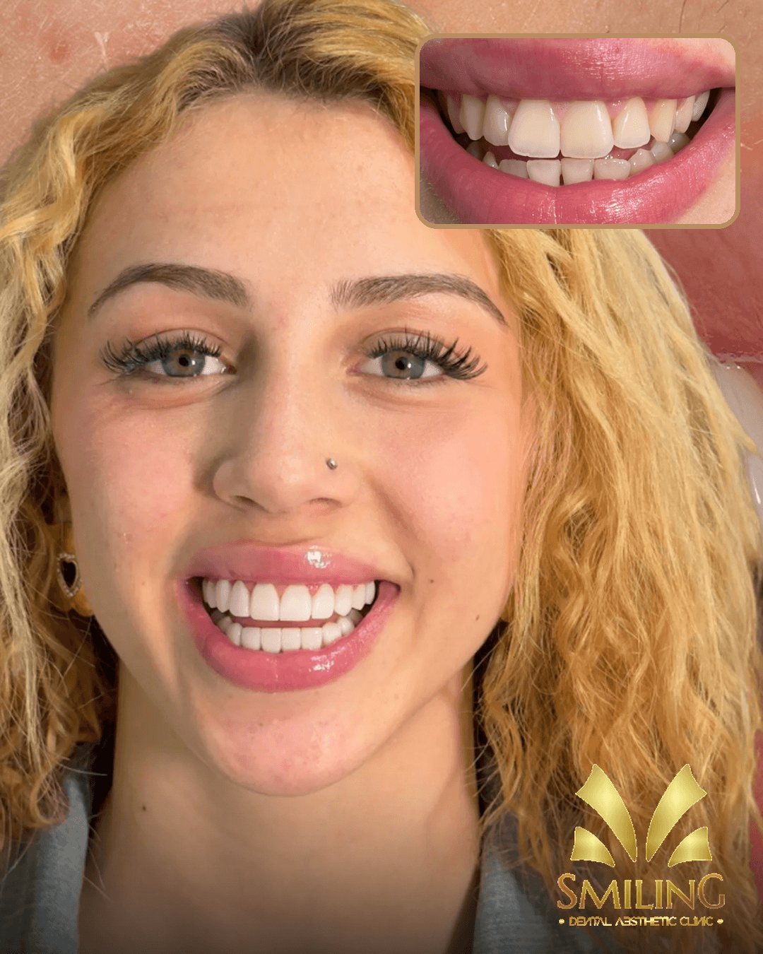 Paciente de Smiling tras su diseño de sonrisa