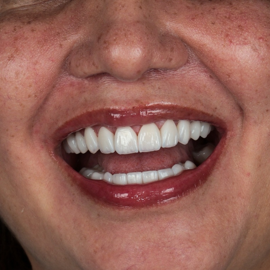 La sonrisa de Angélica · Después del tratamiento