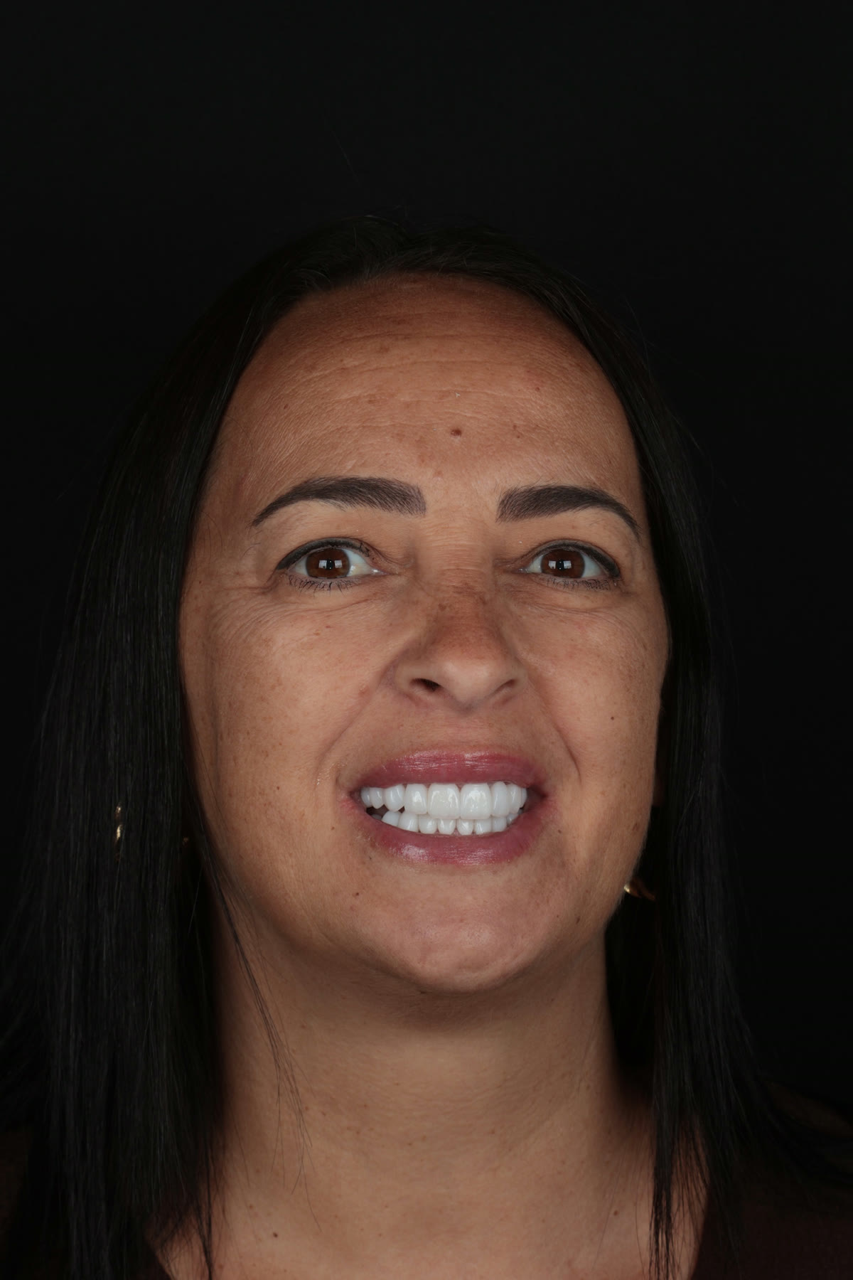 Caso real de carillas con alto realismo dental en Smiling