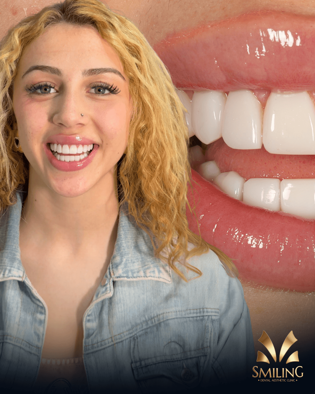 Paciente de Smiling tras su diseño de sonrisa