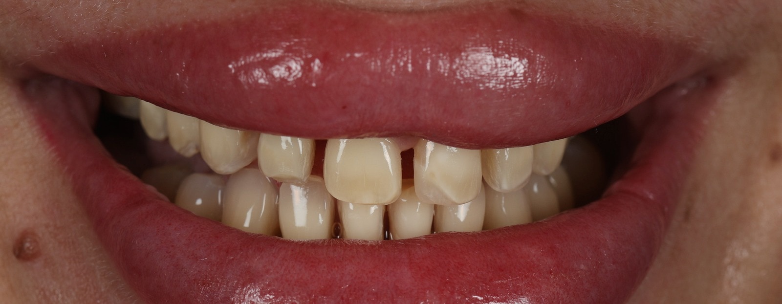 La sonrisa anterior de la paciente, antes de su diseño de sonrisa en Smiling