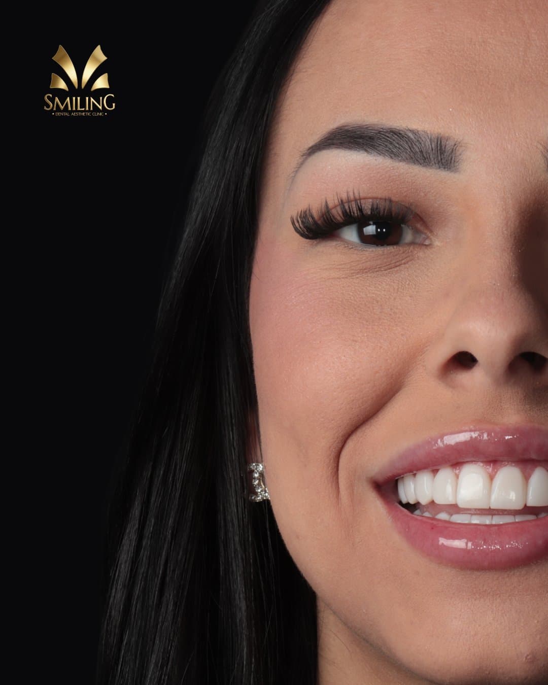 Detalle de una sonrisa tratada con composite en Smiling Clinics
