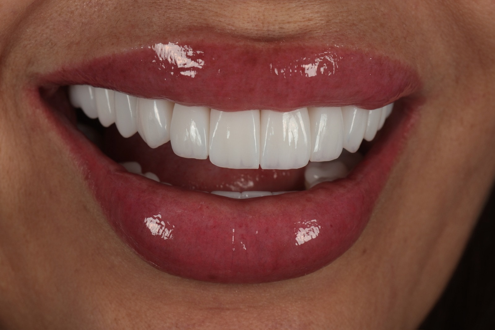 Composite impreso 3D · caso de Smiling