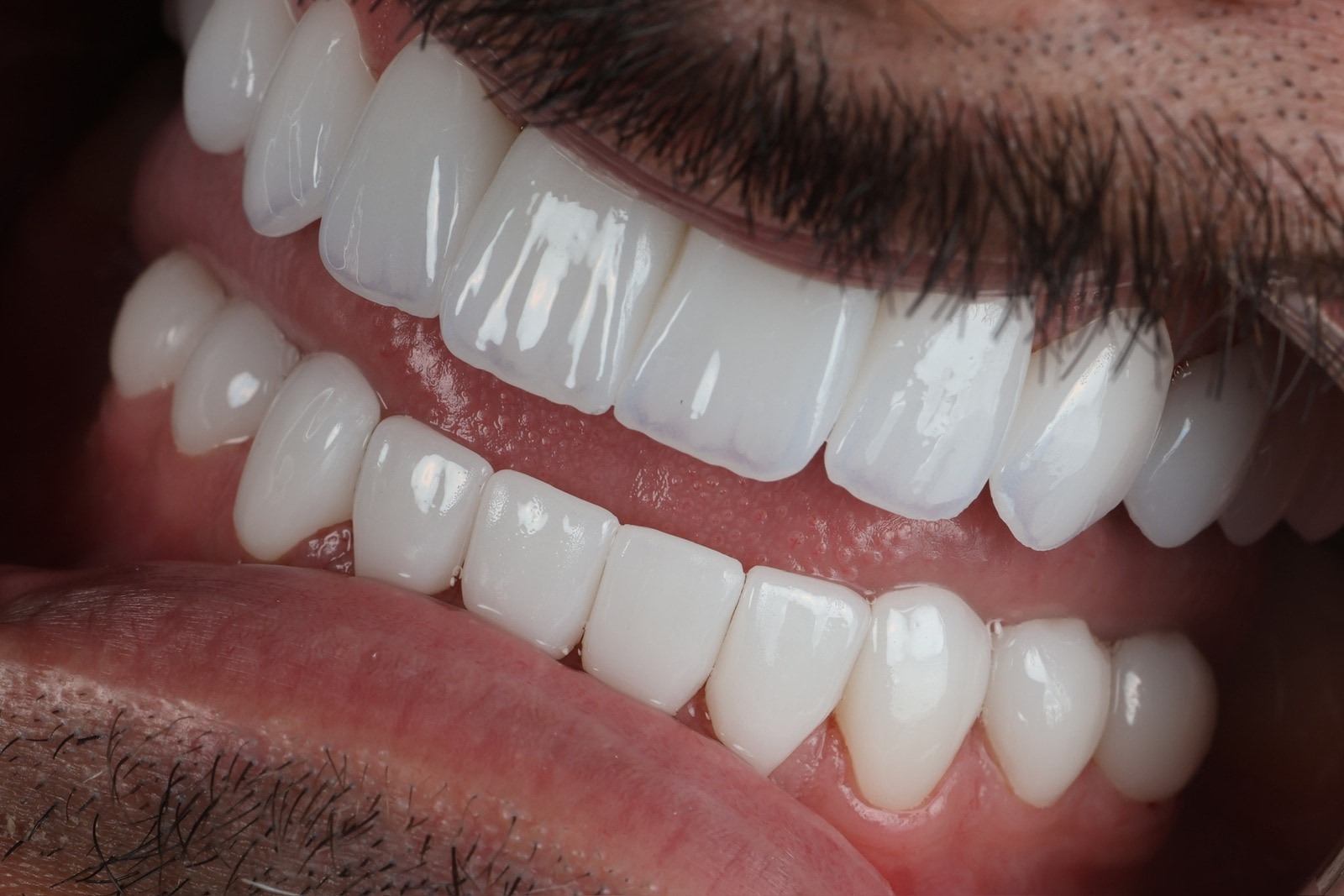 Zirconio · caso de Smiling