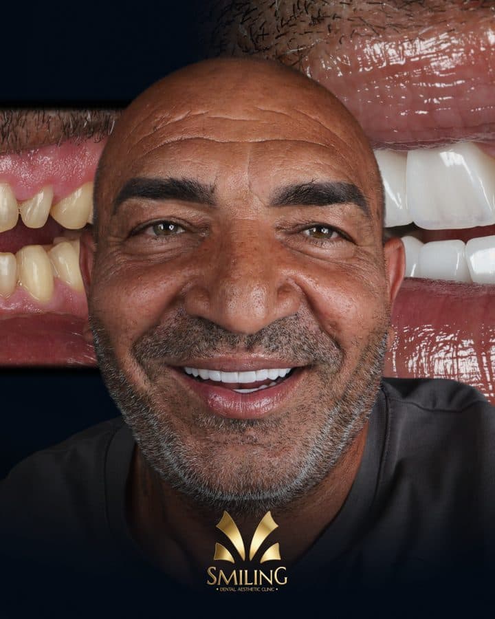 Paciente de Smiling Clinics tras una rehabilitación estética